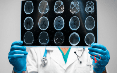 FAST Isn’t Fast Enough: The Overlooked Stroke Signs in Women Under 50